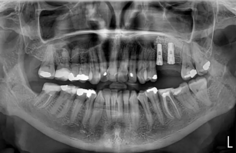 Vše, co byste měli vědět o zubních implantátech